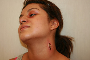 infected neck wound...