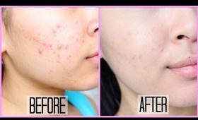 How To: Cover Acne Scars/Marks With Drugstore Products (Not Cakey)!