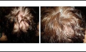 Women Hair Loss  (1.4F)