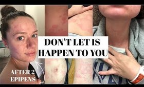 An Infection Sent Me to the ER with a Severe Allergic Reaction