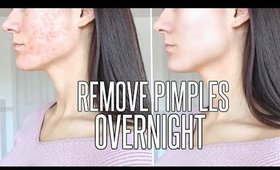 How To Get Rid Of Pimples OVERNIGHT