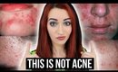 5 Things You THINK Are Acne - BUT ARE NOT! || Jess Bunty
