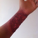Healing burn/zombie wound
