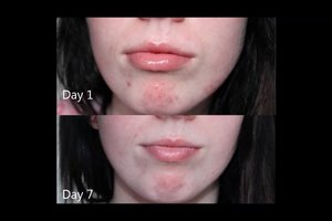 My first week update of using the Clinique Anti Blemish Solutions 3 Step System.
Check out my progress in my videos on my youtube channel: www.youtube.com/chloeluckinphotos