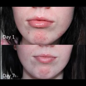 Updates on Clinique Anti Blemish Solutions 3 Step System 