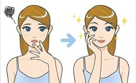 How to Get rid of Acne Scars in 10 Days | Acne Marks Remedies || SuperWowStyle Prachi