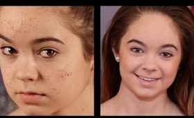 Acne Coverage Foundation Routine!