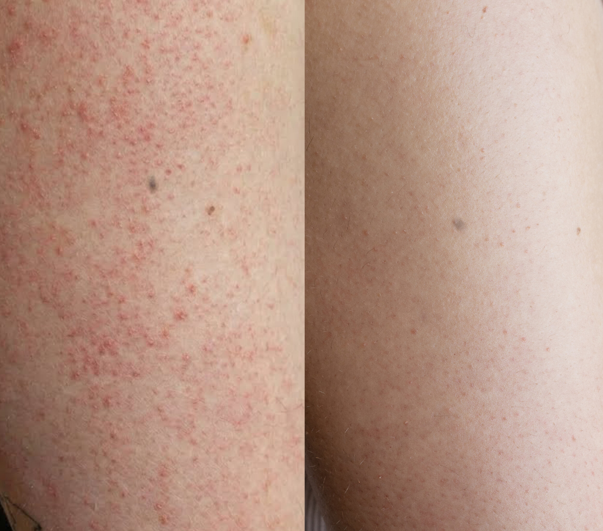 Before and after using the Resurfacing Body Cleanser