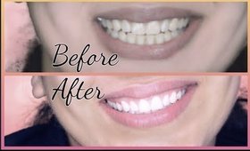 Teeth Whitening At Home In 10 Minutes || How To Whiten Your Yellow Teeth Naturally || 100% Effective