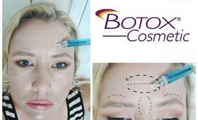 Botox changed my life!