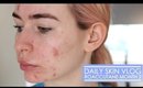 Roaccutane Daily Skin Vlog - Month 2
