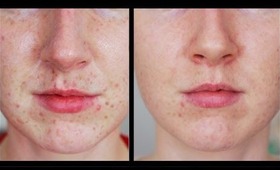 Freckles Be Gone! - My Laser Experience