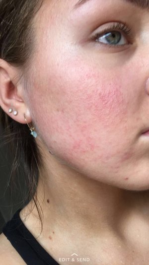 Makeup Allergic Reaction!! | Beautylish
 Makeup Allergic Reaction