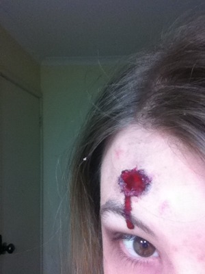 Bullet wound