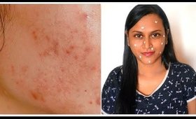 முகப்பரு தழும்புகளை எப்படி குறைப்பது | சுலபமான முறைவில் | Get Rid of Acne Scars