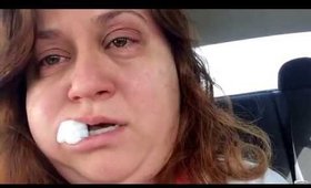Julog #26: Wisdom tooth surgery #itgetsbetter
