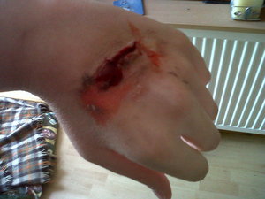 hand wound