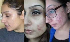 Clear ACNE in 6 weeks naturally | RajiOsahn