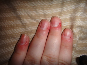 omg... so i have this like nervous/bored thing that i do.. i tend to bite the sides of my nail, not the nail its self, but like the skin around it... dont know why i do it, i know its gross, and it hurts really bad... but like 80% of the time i dont realize that i am doing it so it gets bad.... how can i stop this.. majority of this was done from tonight... :/
