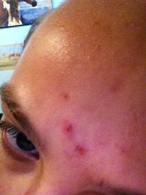 Ok..I screwed up and picked my pimple scabs...school starts tomorrow