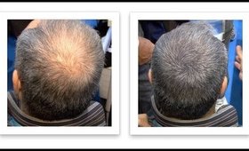 New Solution For Hair Loss