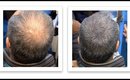 New Solution For Hair Loss