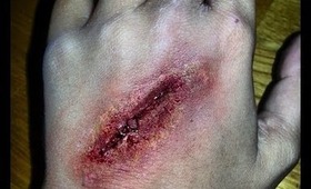 Infected Laceration