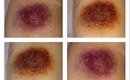 Severe Bruises | SFX Makeup Tutorial ♥