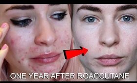 ONE YEAR AFTER ROACCUTANE | MY SKIN NOW