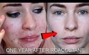 ONE YEAR AFTER ROACCUTANE | MY SKIN NOW