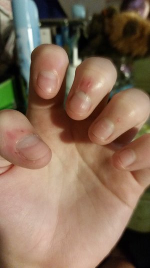 3 Simple Home Remedies For Peeling Skin Around Nails That Are Magic! -  Boldsky.com