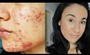 Acne Coverage Foundation Routine | Full Coverage for Cystic Acne/Scarring