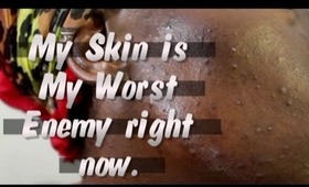 Worst Acne Break Out I ever Had (Facial Insecurities)