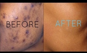 Dark Spots Fade Away | Remove Dark Spots Extract White Heads