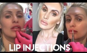 MY LIP INJECTIONS WITH JUVÉDERM ULTRA PLUS