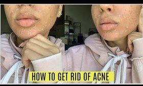 HOW I GOT RID OF ACNE IN 5 DAYS! (ONLY THING TO WORK)