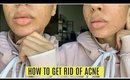 HOW I GOT RID OF ACNE IN 5 DAYS! (ONLY THING TO WORK)