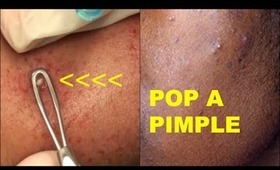 POP A PIMPLE LEAVE NO SCAR | DETAILED TUTORIAL #SKINCARESUNDAY
