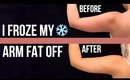 I FROZE MY ARM FAT OFF | Coolsculpting Before and After