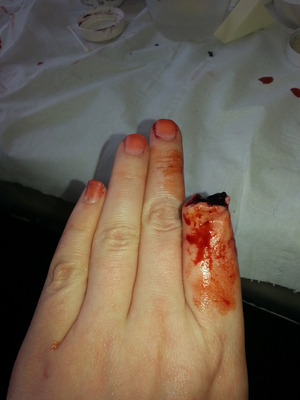 Basically just a quick missing finger using scar wax I did today whilst bored at college. For more images like these check out my Facebook page :D https://www.facebook.com/pages/Emilyguysfx/169544763169171
