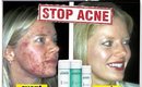Comment éradiquer son acné ? Ma réponse PROACTIV