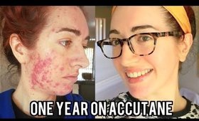 ACCUTANE: Before And After Severe Acne (With Pictures) My Experience | Jess Bunty