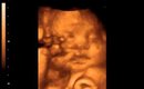 Logans 3D/4D Ultrasound Clip