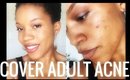 How I Cover My Adult Acne Using High End Products
