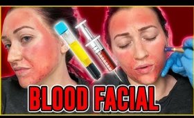 I Got The Vampire Facial for Acne Scars- Worth the $$$??