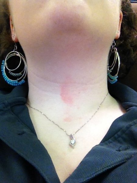 mysterious-red-mark-on-my-neck-wtf-beautylish