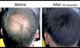 Hair Loss Crown