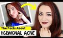 HORMONAL ACNE FACTS : What Is It, What Causes It & How To Treat it!