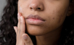 Acne Aftermath: How to Fade & Conceal Acne Scars