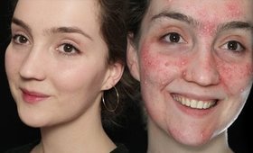 Skin Transformation Makeup (How Acne Adverts Work)